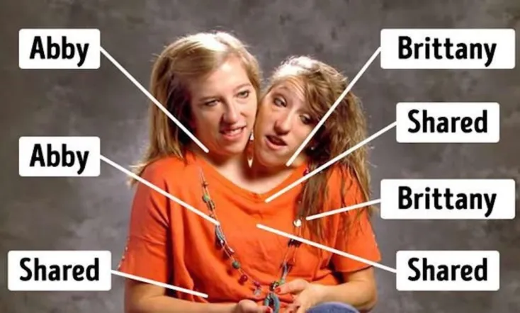 The Twins Who Share A Body