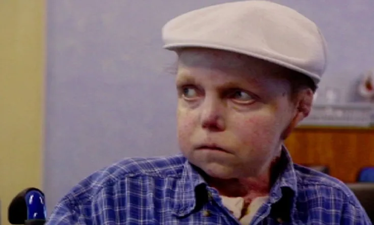 The Boy Whose Skin Fell Off